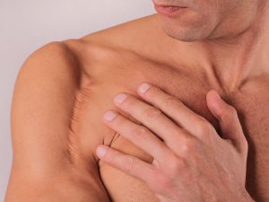 Get rid of scar tissue