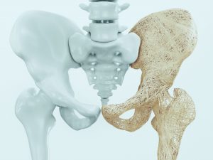 Physiotherapy for Osteoporosis - How it can help you