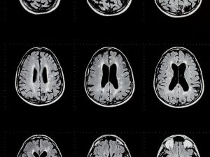 Multiple Sclerosis Pain Management - What treatments can help?