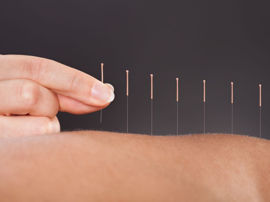 Does acupuncture work? What the studies tell us Perea Clinic