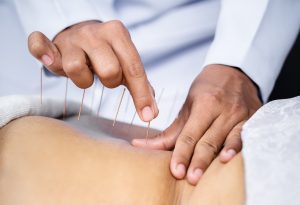 Acupuncture treatments