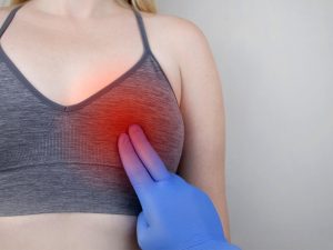 symptoms of mastitis