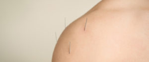 dry needling angel islington