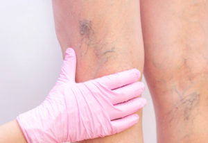 anticellulite massage islington