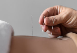acupuncture treatment islington