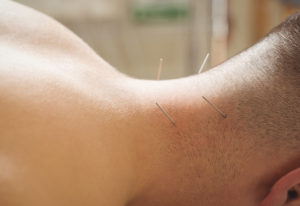 dry needling islington