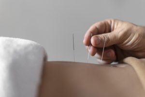 Acupuncture Islighton Angel