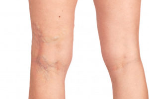 circulation massage islington