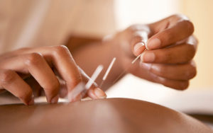 What to expect during my acupuncture session in islington perea