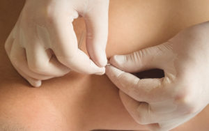 what is dry needling