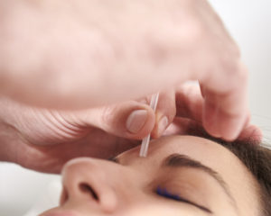 Acupuncture Islighton Angel