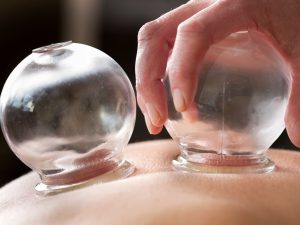 cupping therapy