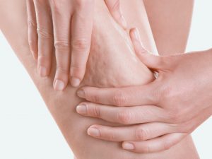 How to prevent cellulite