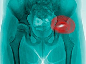 Femoroacetabular impingement (FAI)