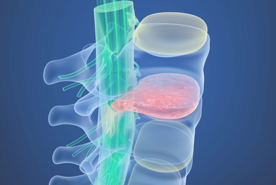 Effective Treatments For Slipped disc Osteopathy Clinic London