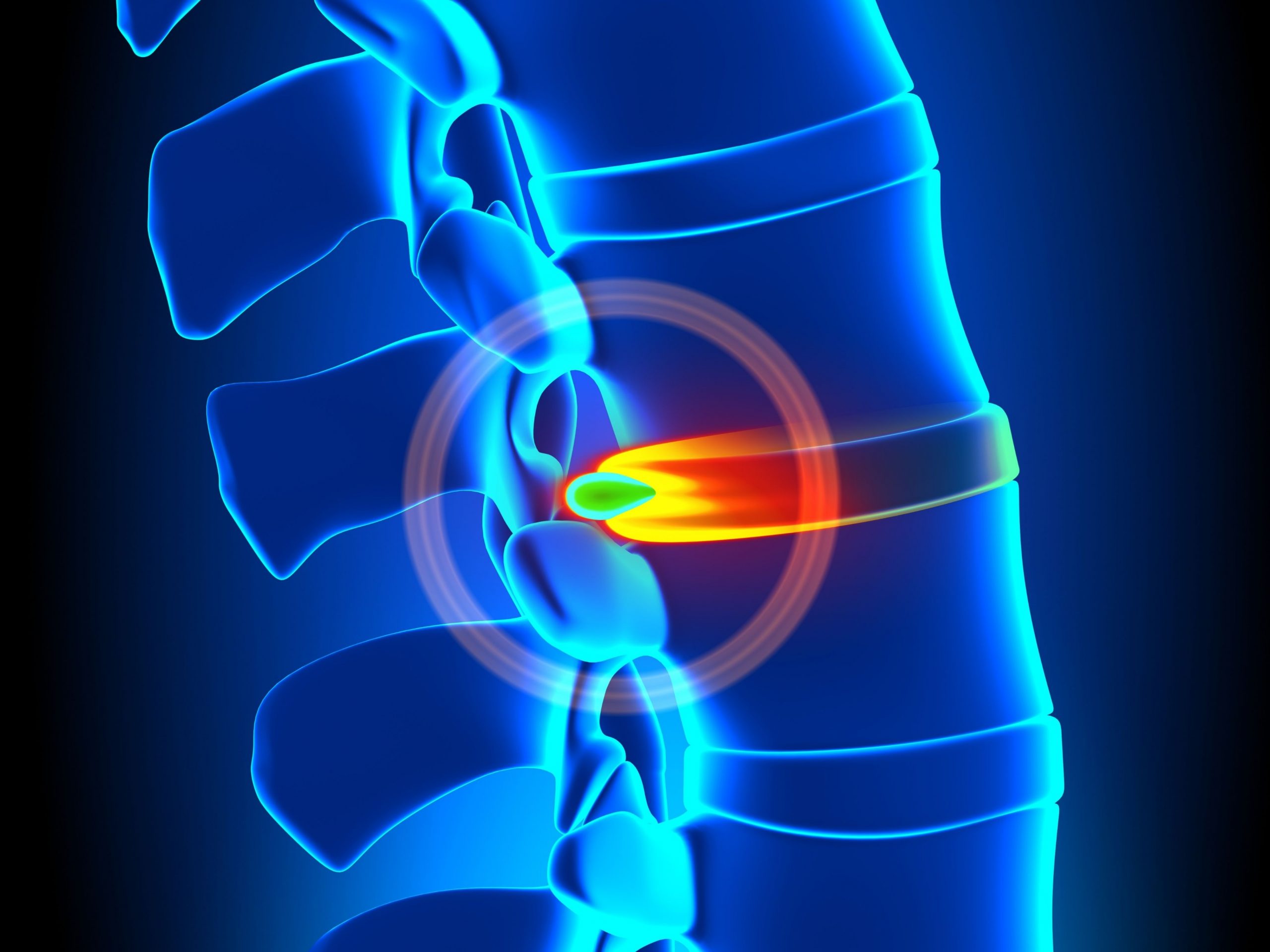 Understanding spine disc pain! 