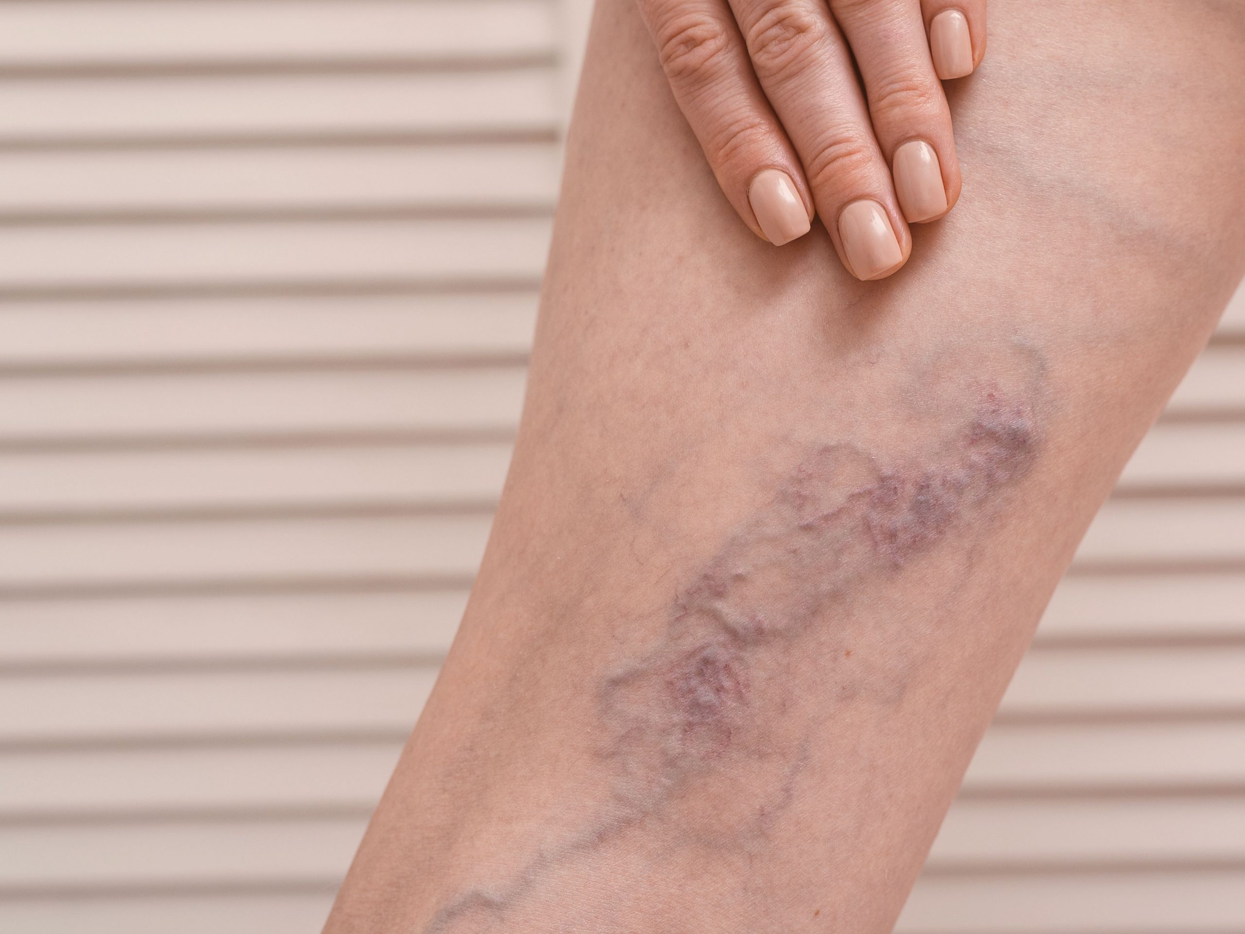 Can working from home cause DVT (Deep Vein Thrombosis)?