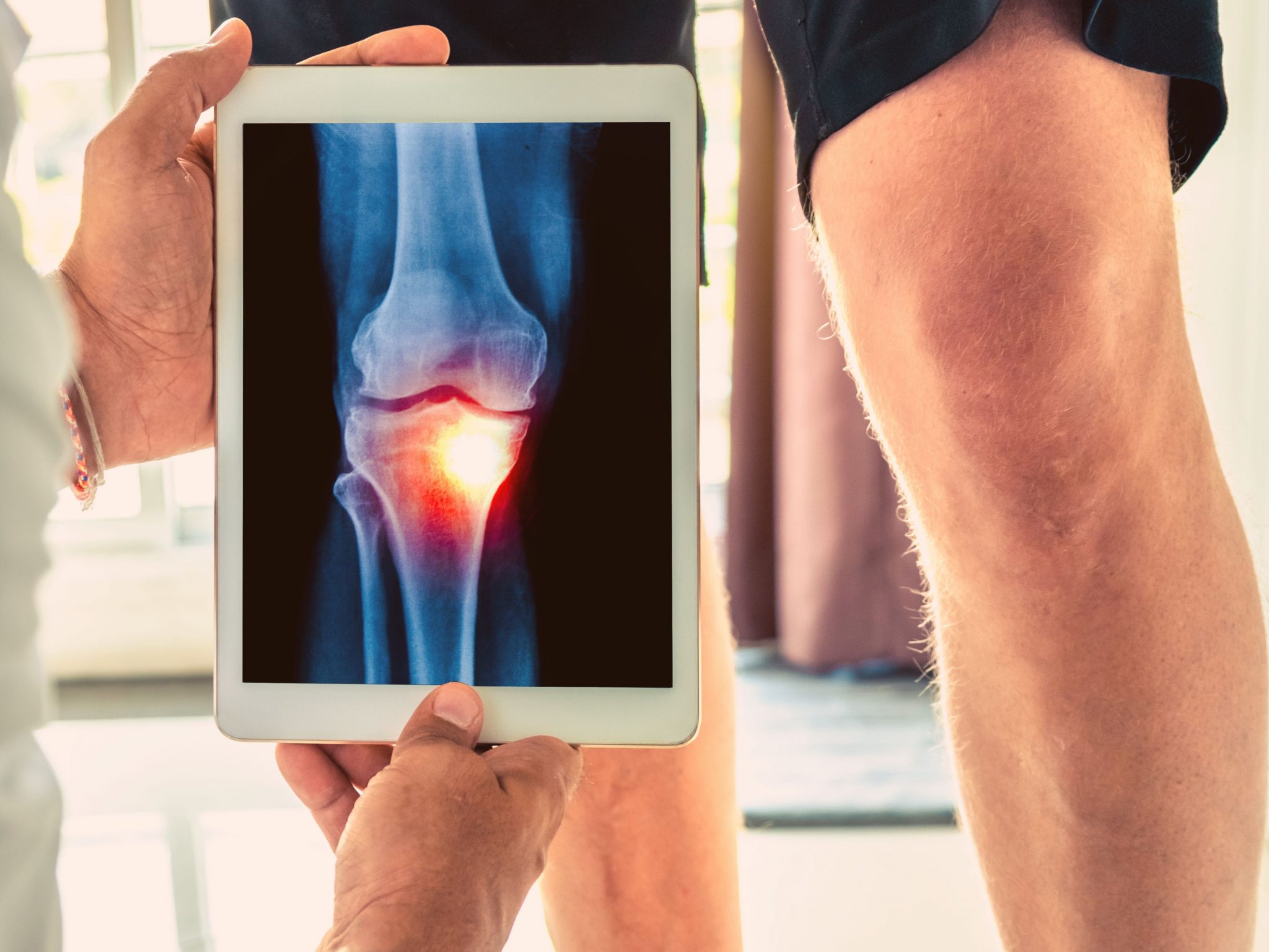 Wearandtear arthritis what exercise can do for you Perea Clinic