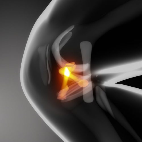 ACL(Anterior Cruciate Ligament) Injury