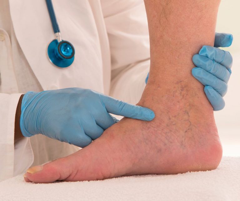 Causes Of Retaining Water In Legs