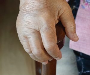 what is dactylitis "sausage fingers" and how lymphatic drainage massage can help