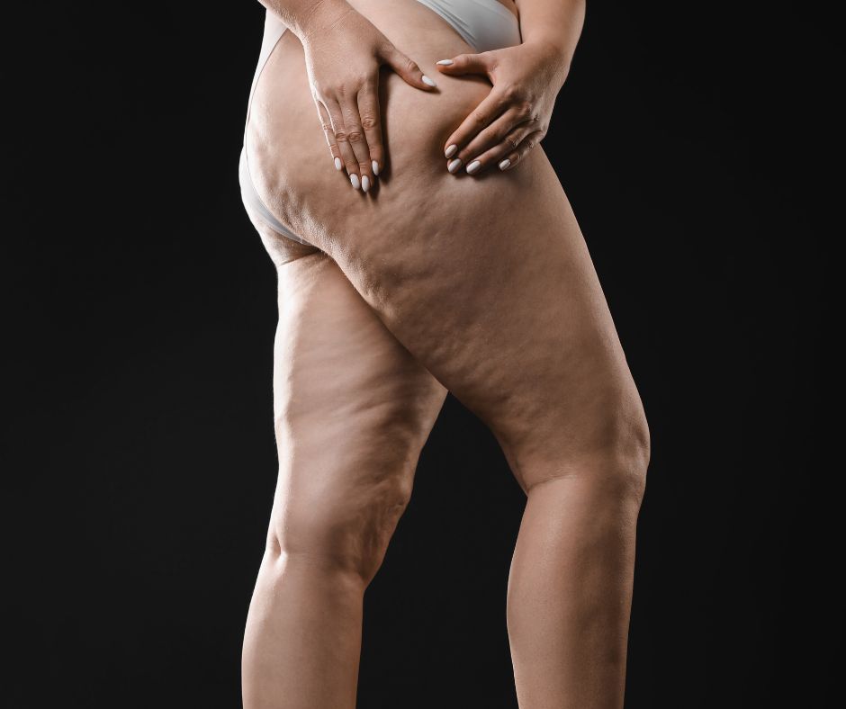 Liposuction for Lymphoedema: When is it Recommended?
