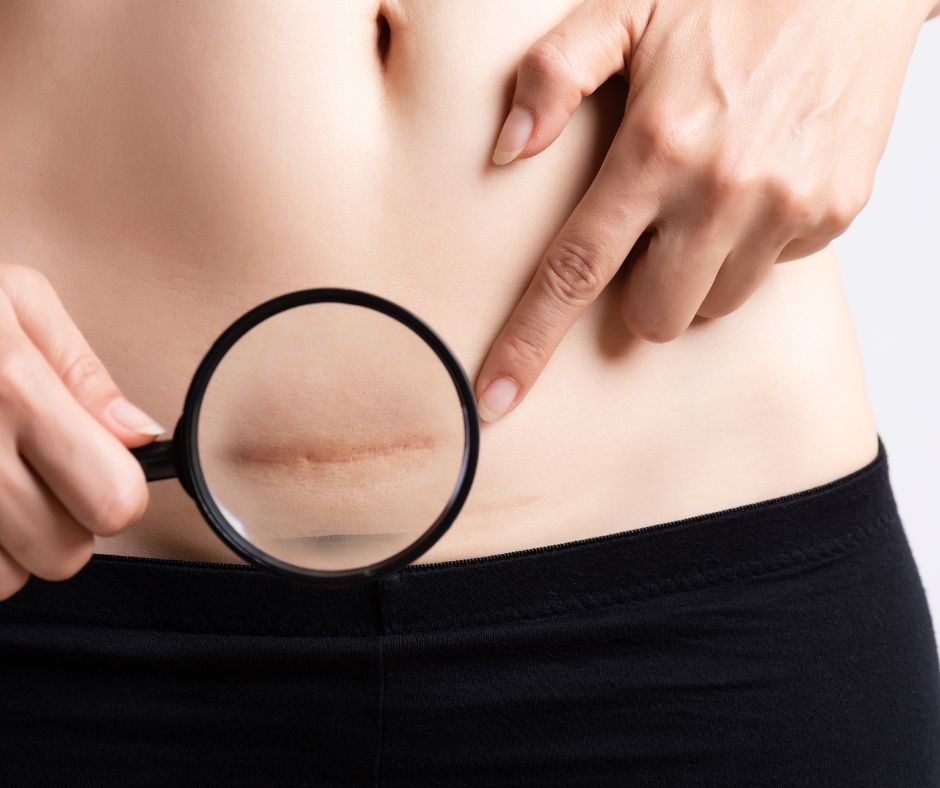 Understanding Post-Surgery Fibrosis: Causes, Symptoms, and Treatment