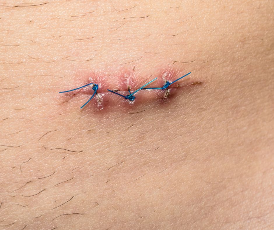 Scar Tissue After Surgery: Characteristics, Stages and Management