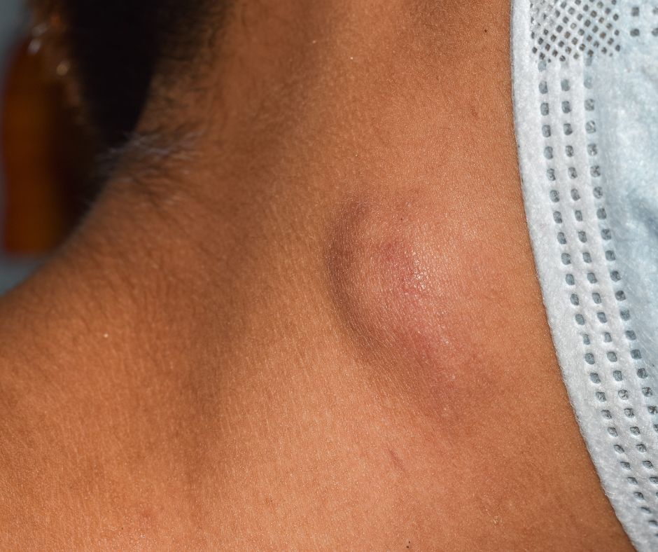 Seromas after Lymph Node Dissection: Causes and Treatment