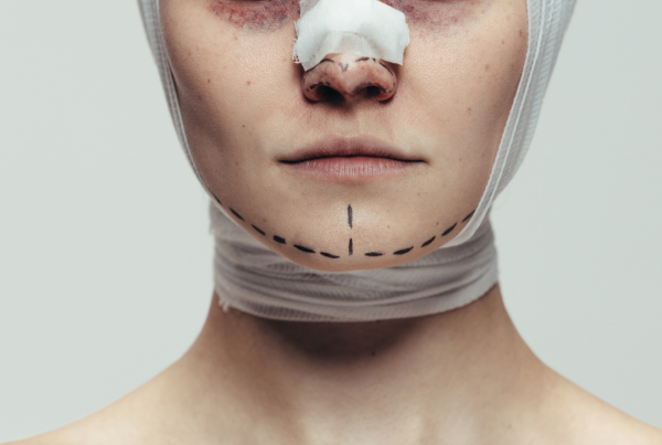 Woman with bandages and bruising after facial cosmetic surgery, during the early stage of recovery